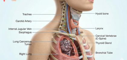 lung cancer symptoms hindi