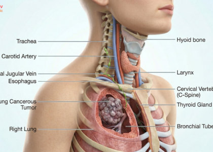 lung cancer symptoms hindi